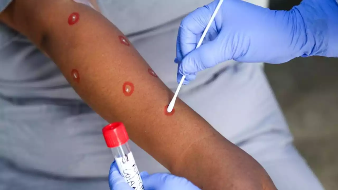 Singapore reports 11th case of monkeypox infection