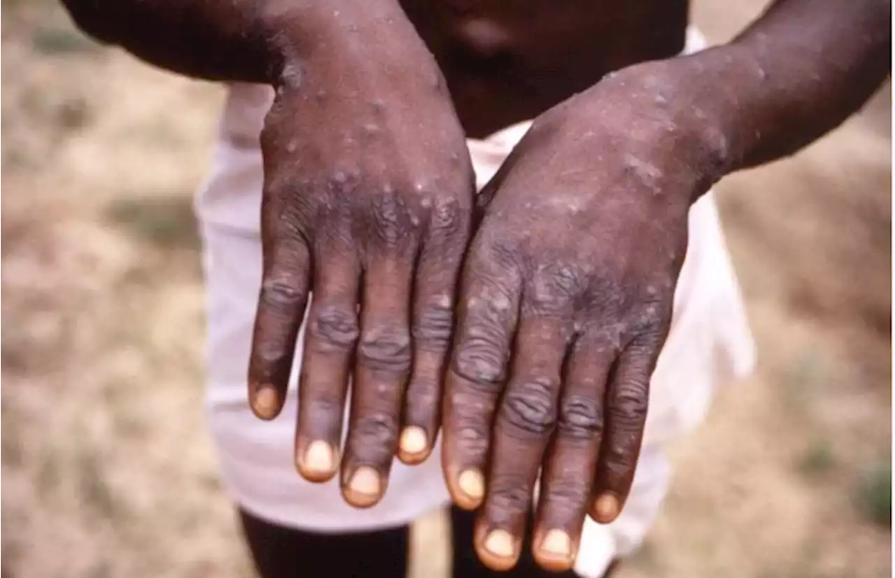 First case of monkeypox detected in PH