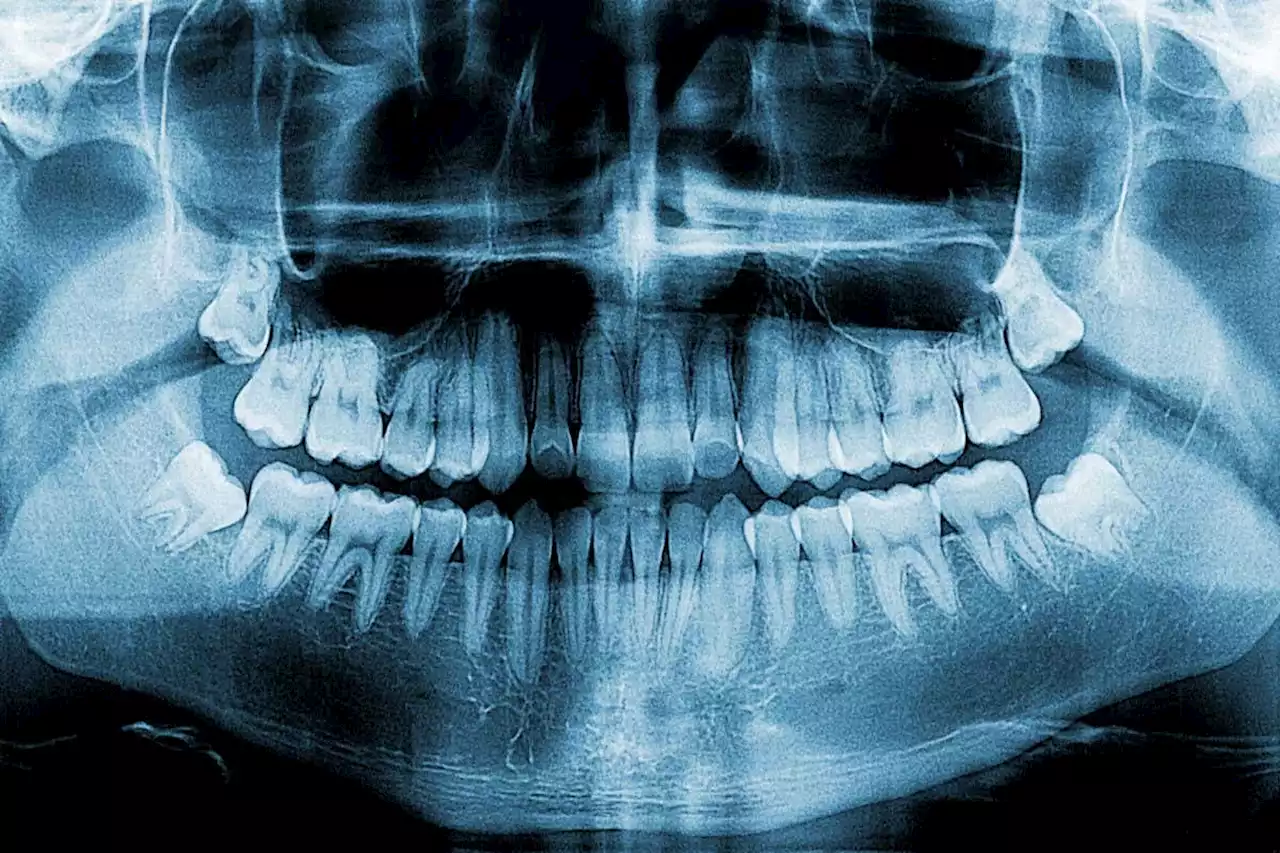 Dental X-rays likely to be used to assess asylum seeker ages in UK