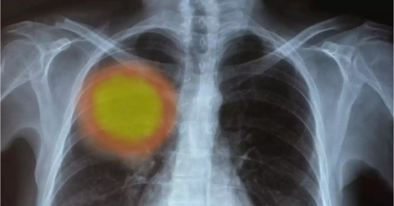 Le cancer du poumon est le plus courant et le plus mortel dans le monde