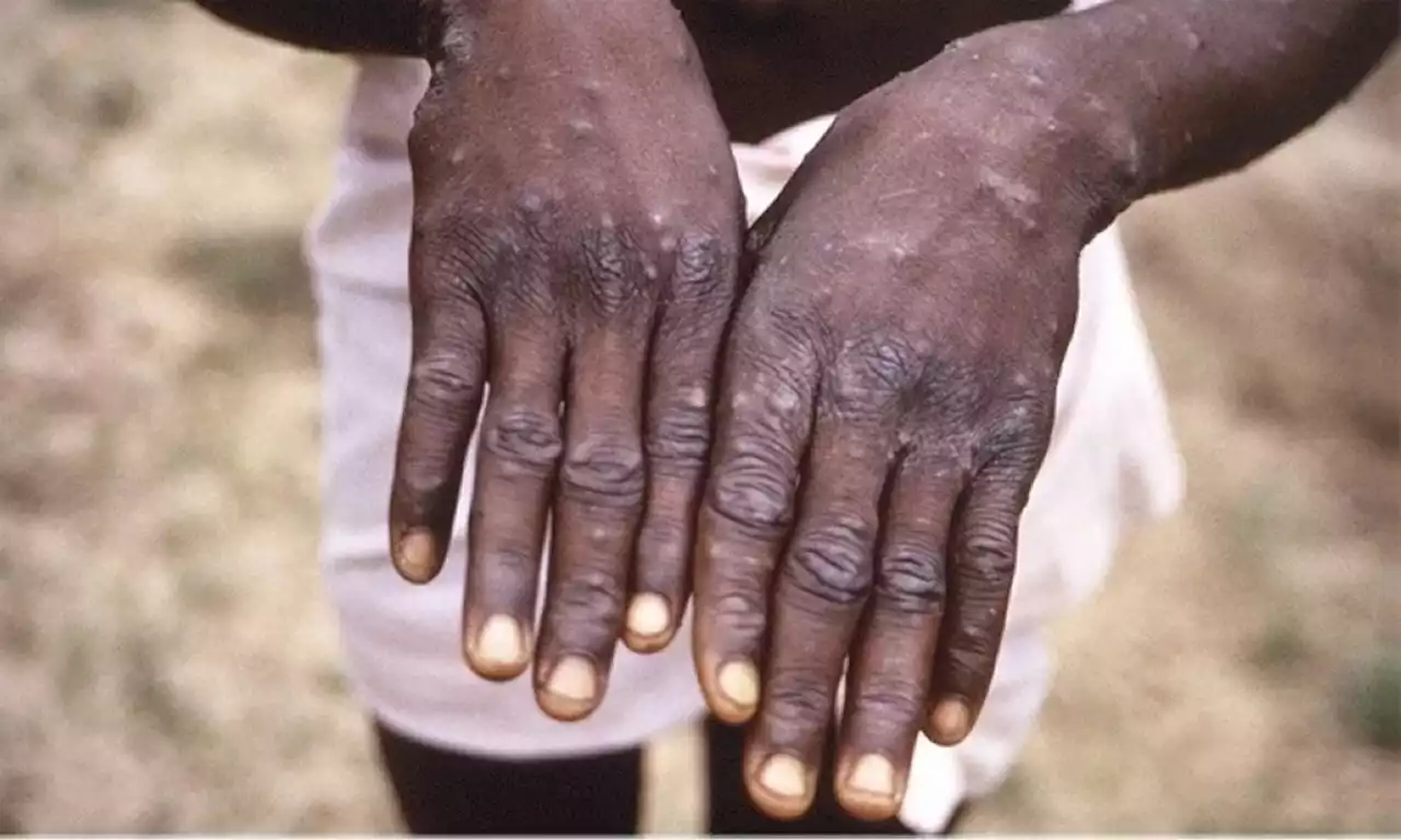 Philippines logs first Monkeypox case