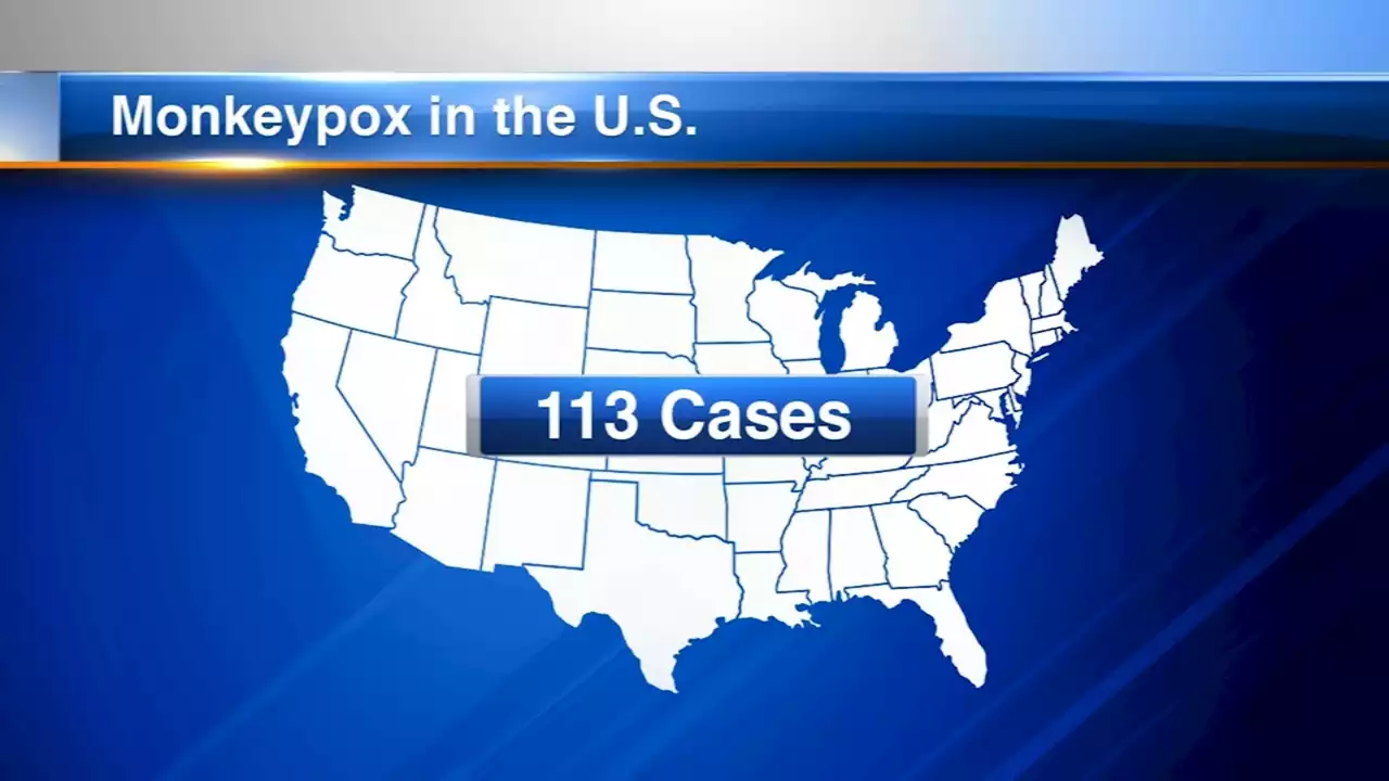 Wisconsin reports 1st confirmed case of monkeypox virus