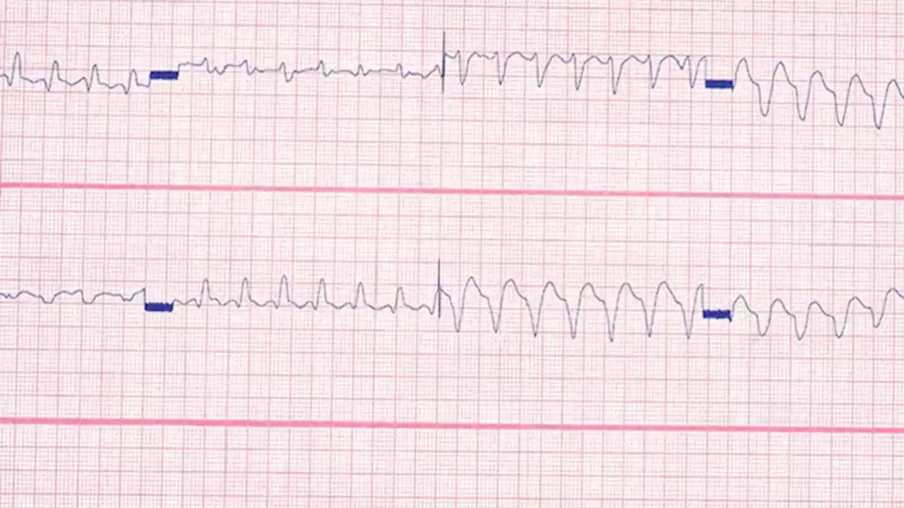 Intentional Overdose in a Suicidal 28-Year-Old With Lupus