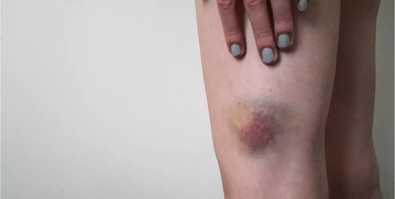 Here’s Why You Bruise So Easily, According to a Doctor