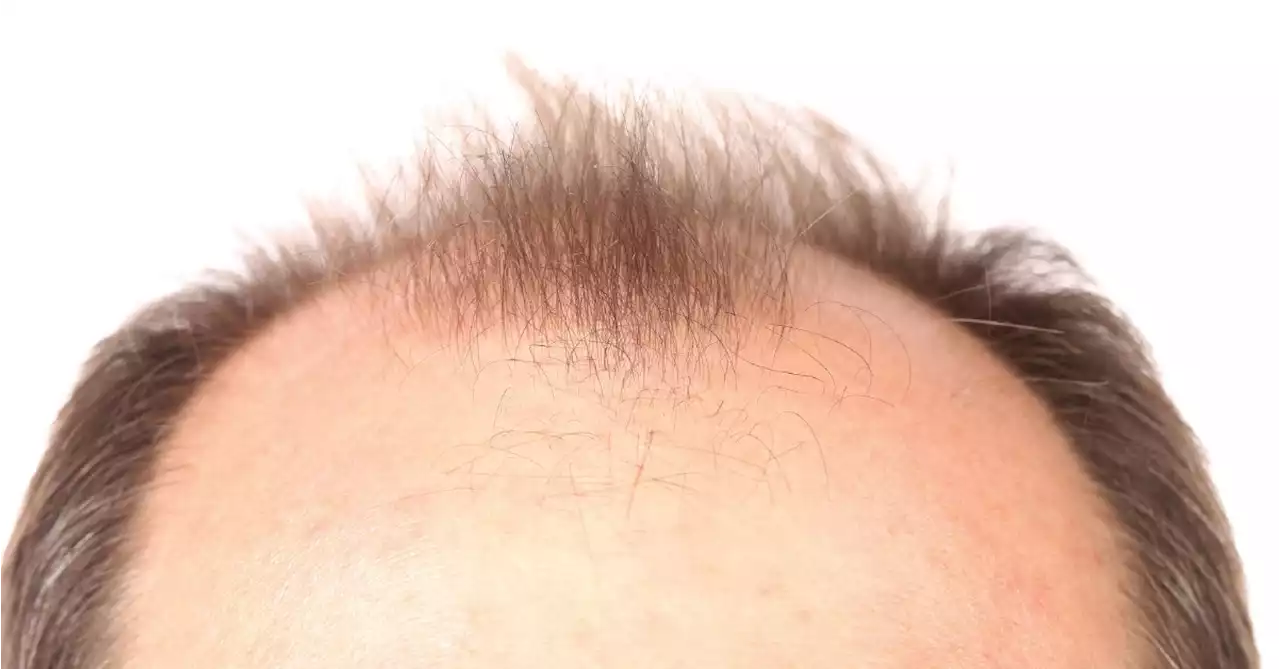 Is Balding Unavoidable? New Research Suggests Not