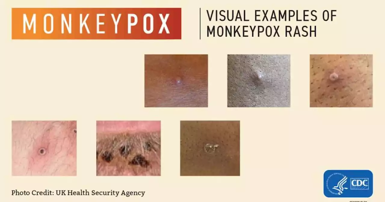 Monkeypox: How it spreads and how to avoid it