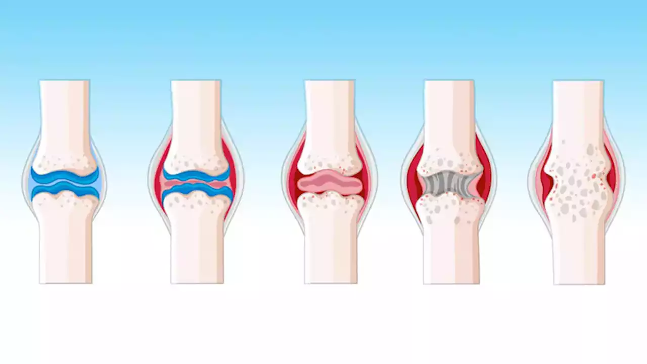 Fast Five Quiz: Mimics of Rheumatoid Arthritis