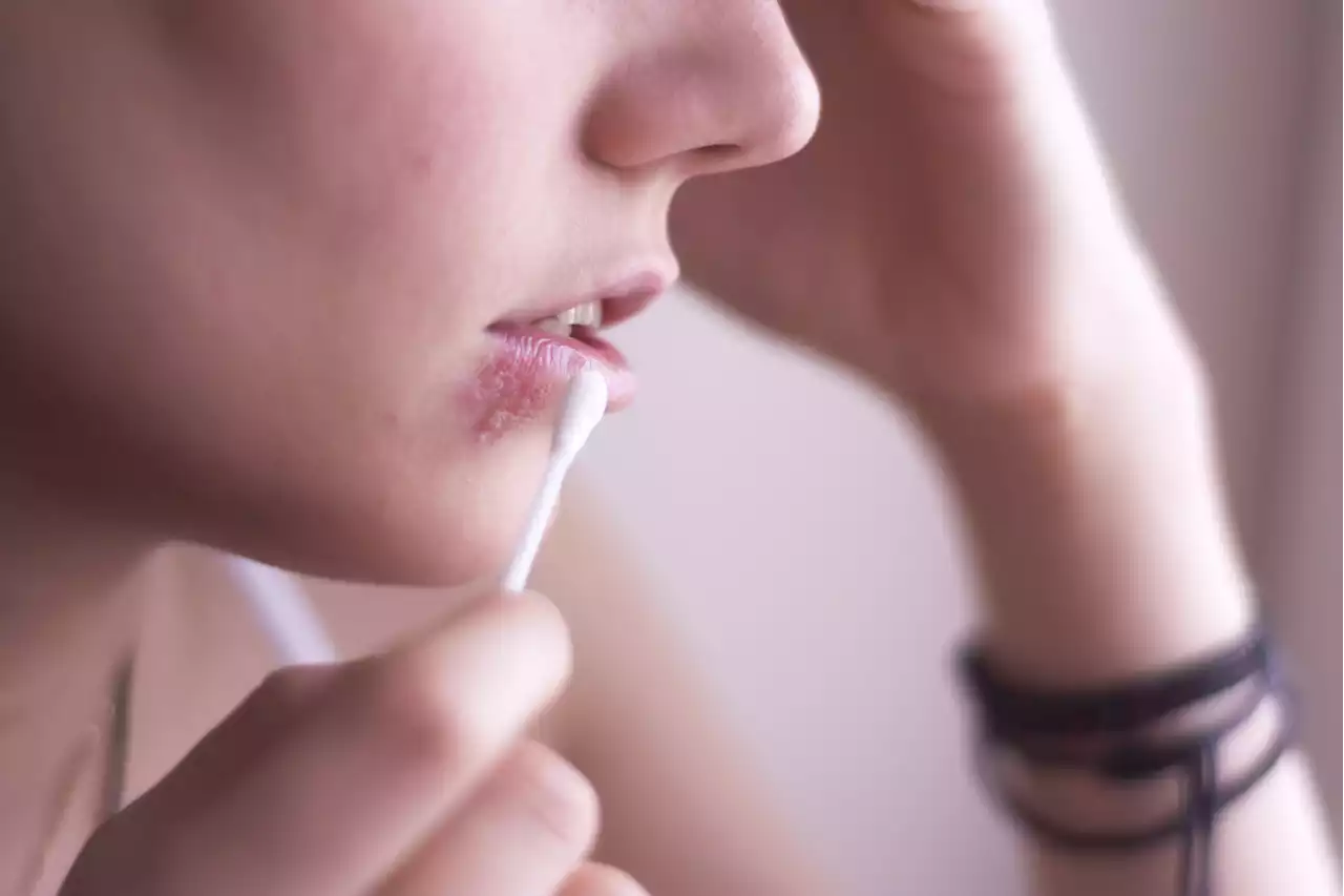 Facial herpes: First kisses may have helped spread cold sore virus | The Citizen