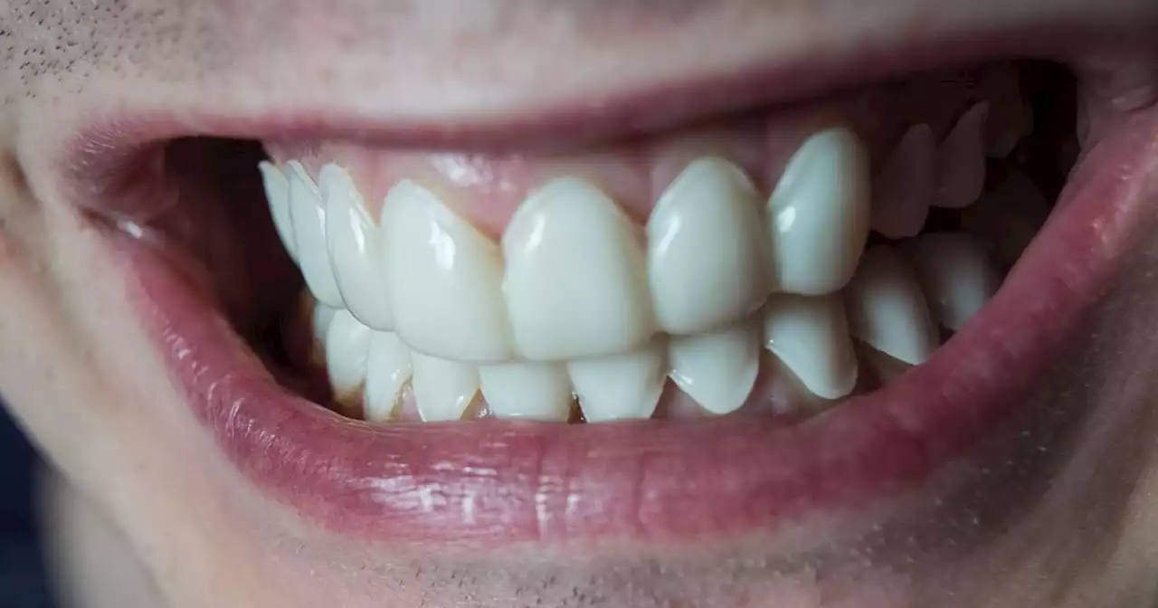 'Turkey teeth' warning after UK clinic is 'inundated' with botched veneers