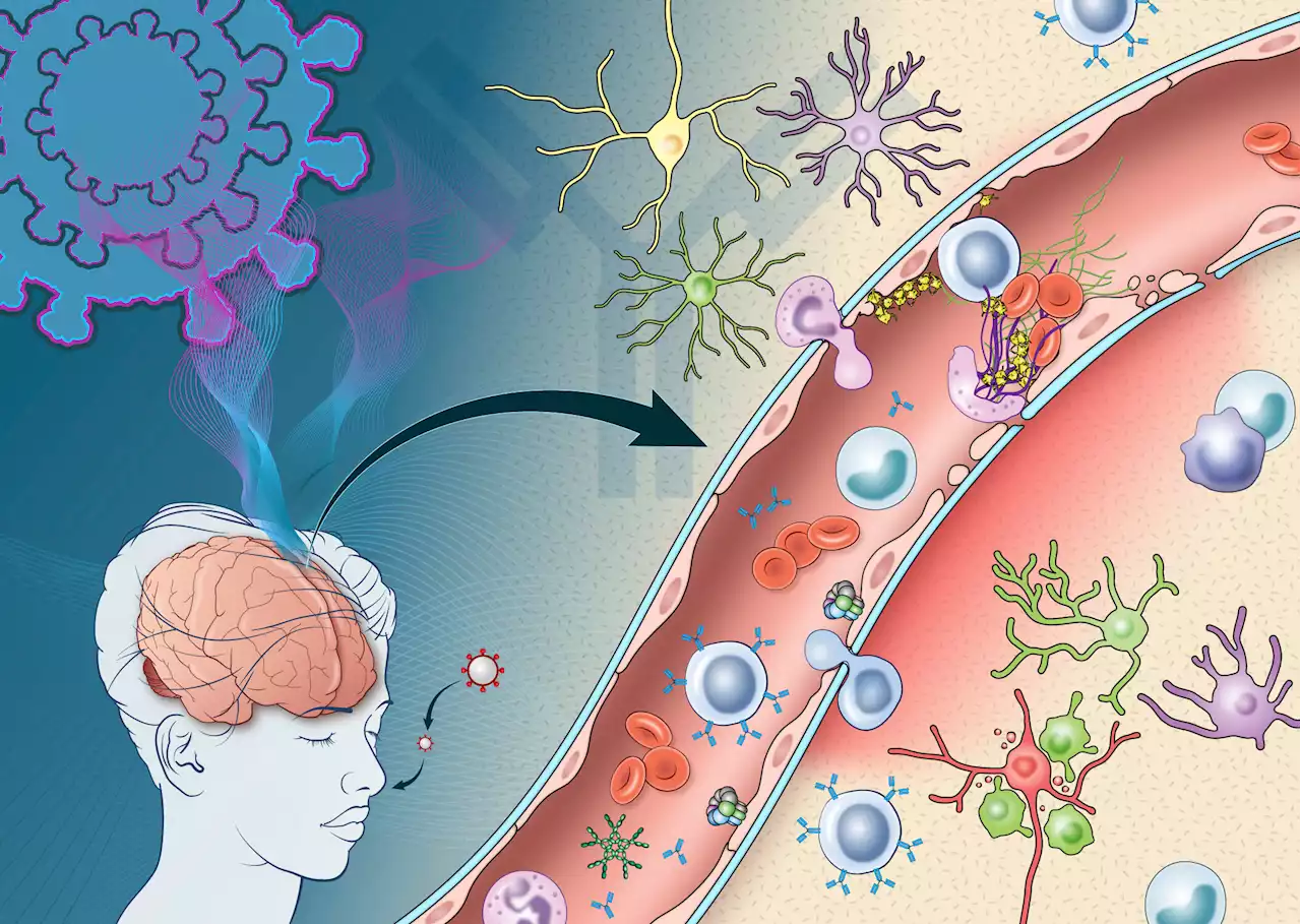 Small study reveals how immune response triggered by COVID-19 may damage the brain