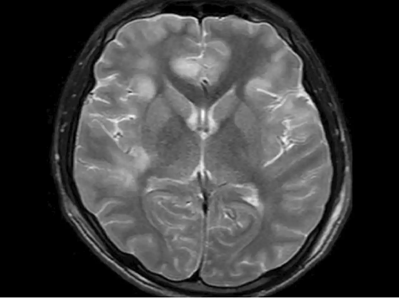 A 16-Year-Old With Quadriparesis After Respiratory Infection