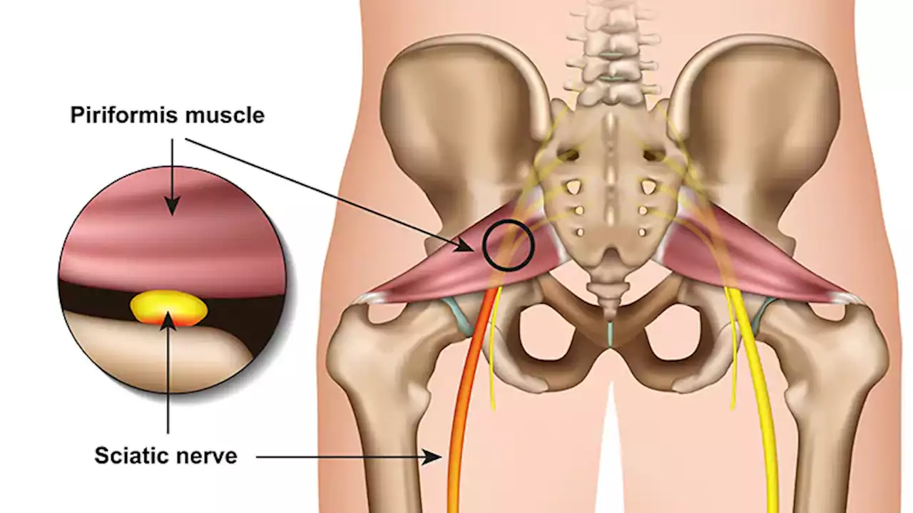 Examination, Diagnosis, and Treatment of Piriformis Syndrome