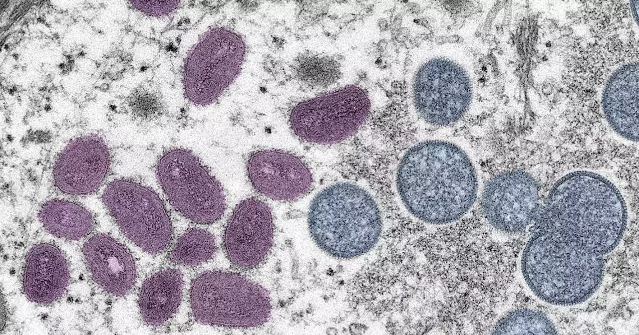 Rising monkeypox cases in San Francisco raise concern among health officials