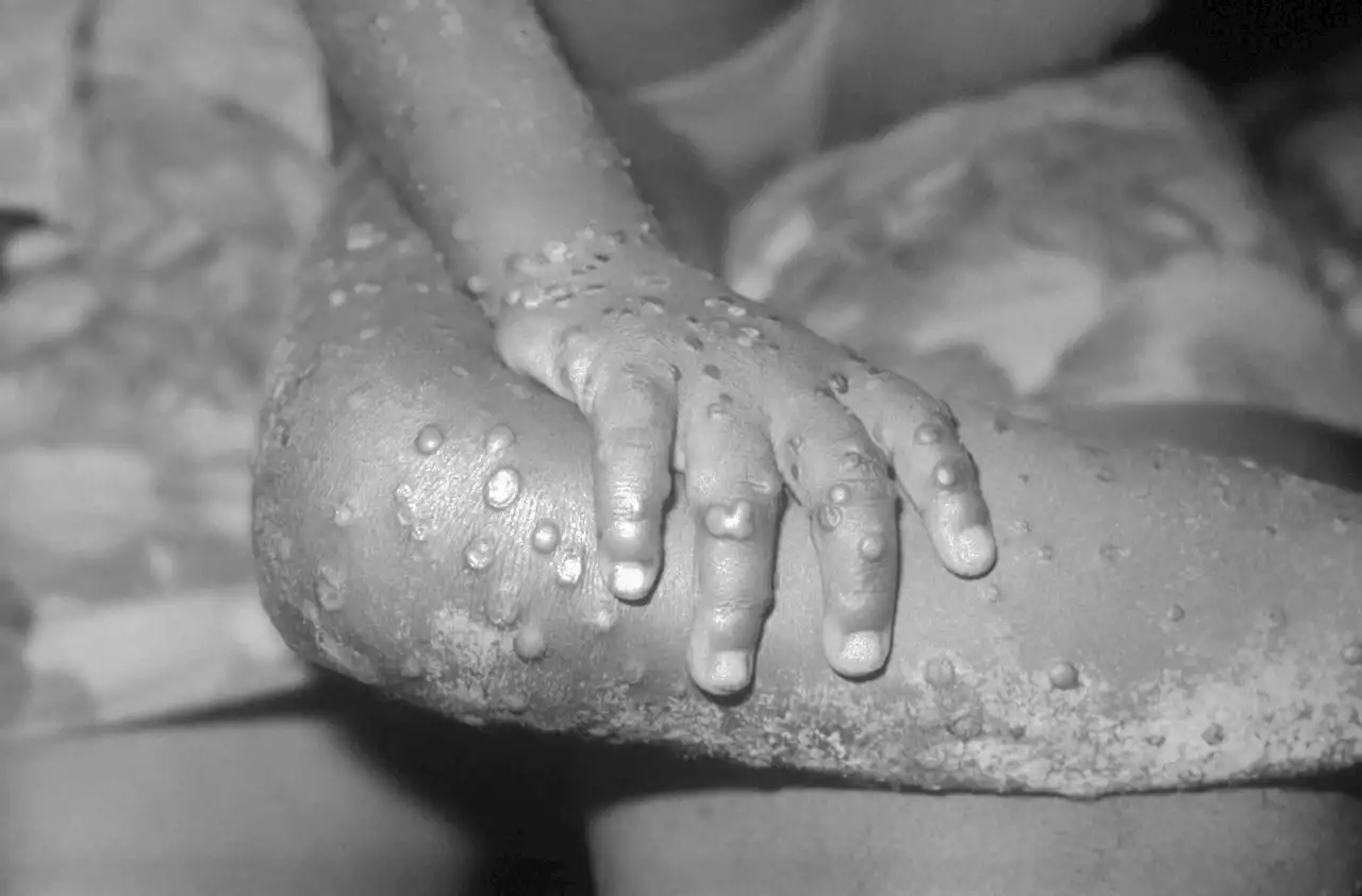 What Is Monkeypox?