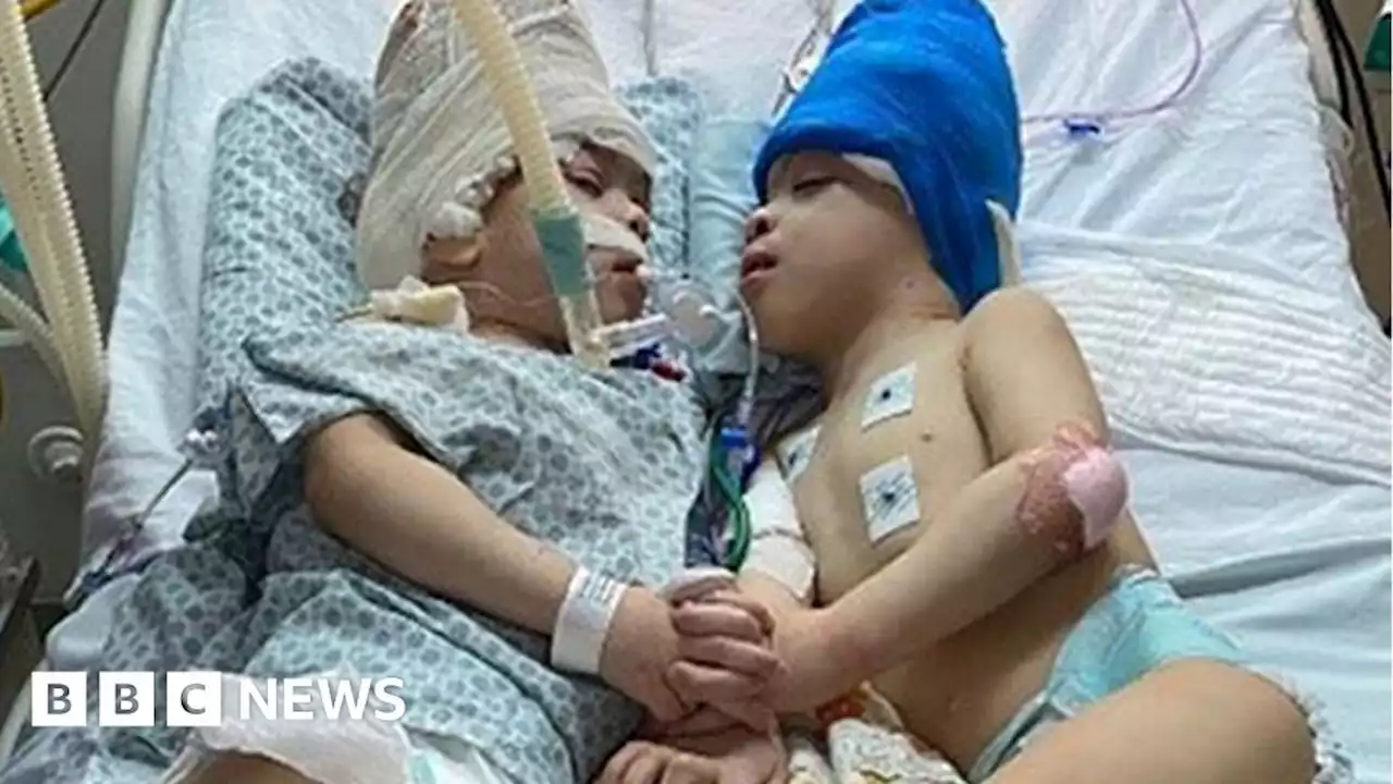 Conjoined twins separated with the help of virtual reality