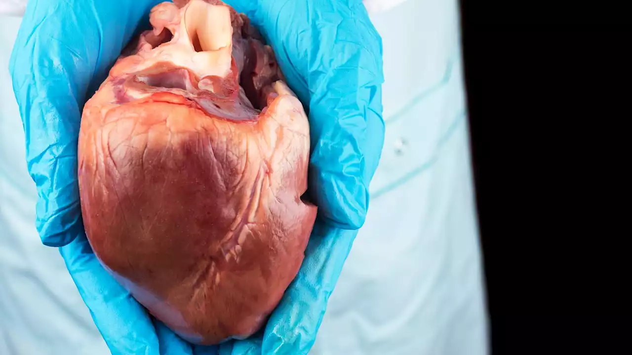 Doctors perform world’s first heart transplant between two HIV-positive patients