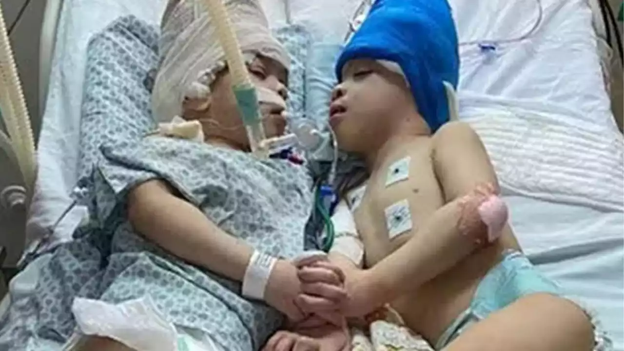 Conjoined twins separated after 27-hour operation hold hands as they recover in hospital