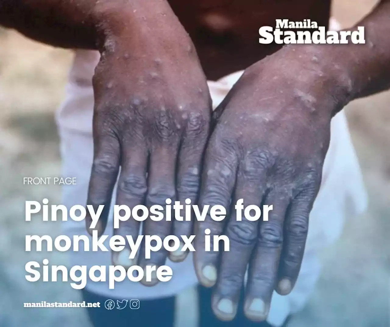 Pinoy positive for monkeypox in Singapore