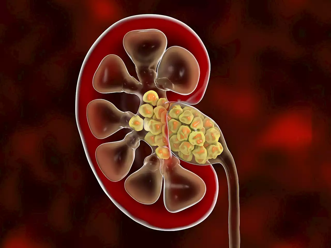 Mayo Clinic Study Uncovers Dietary Trick To Help Prevent Kidney Stones