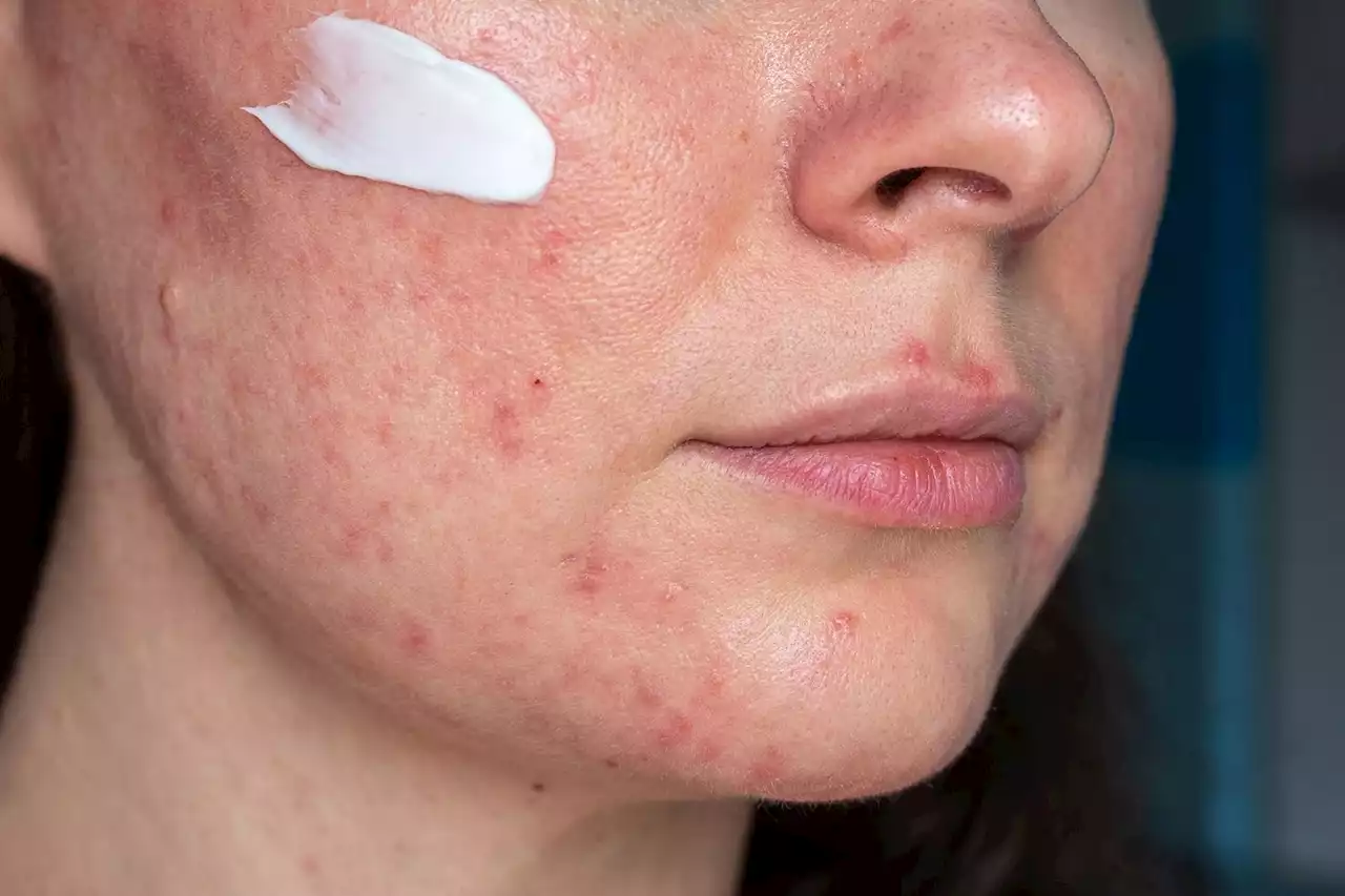 Breakthrough acne treatment set to be available worldwide | The Citizen