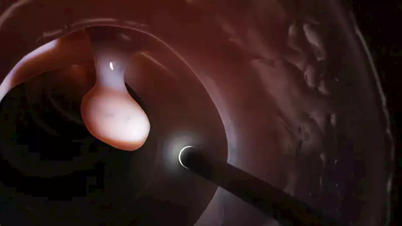 Evidence Mounts for AI During Colonoscopy