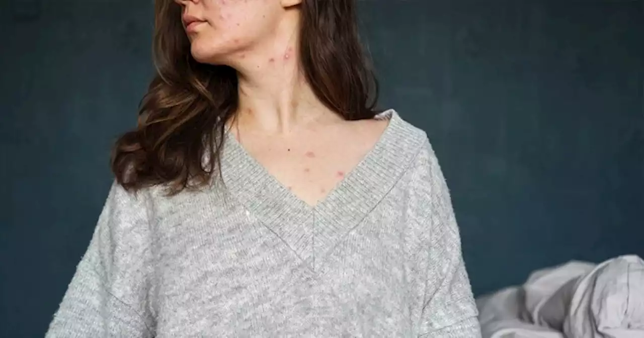 Studies Show Acne Significantly Affects One's Mental Health