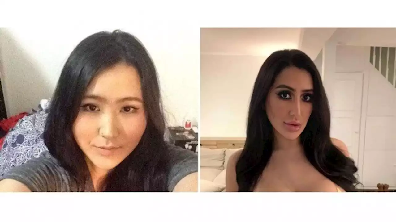 Kecanduan Oplas, Wanita Habiskan Rp900 Juta Demi Mirip Kim Kardashian