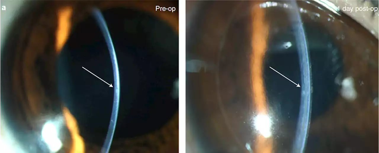 Clinical Trial Restored Sight to 20 People With Corneas Made From An Unlikely Source