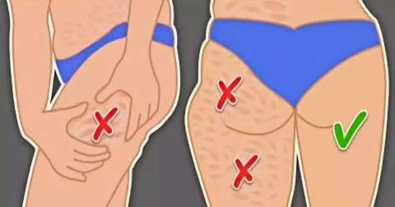 how to get rid of cellulite on buttocks