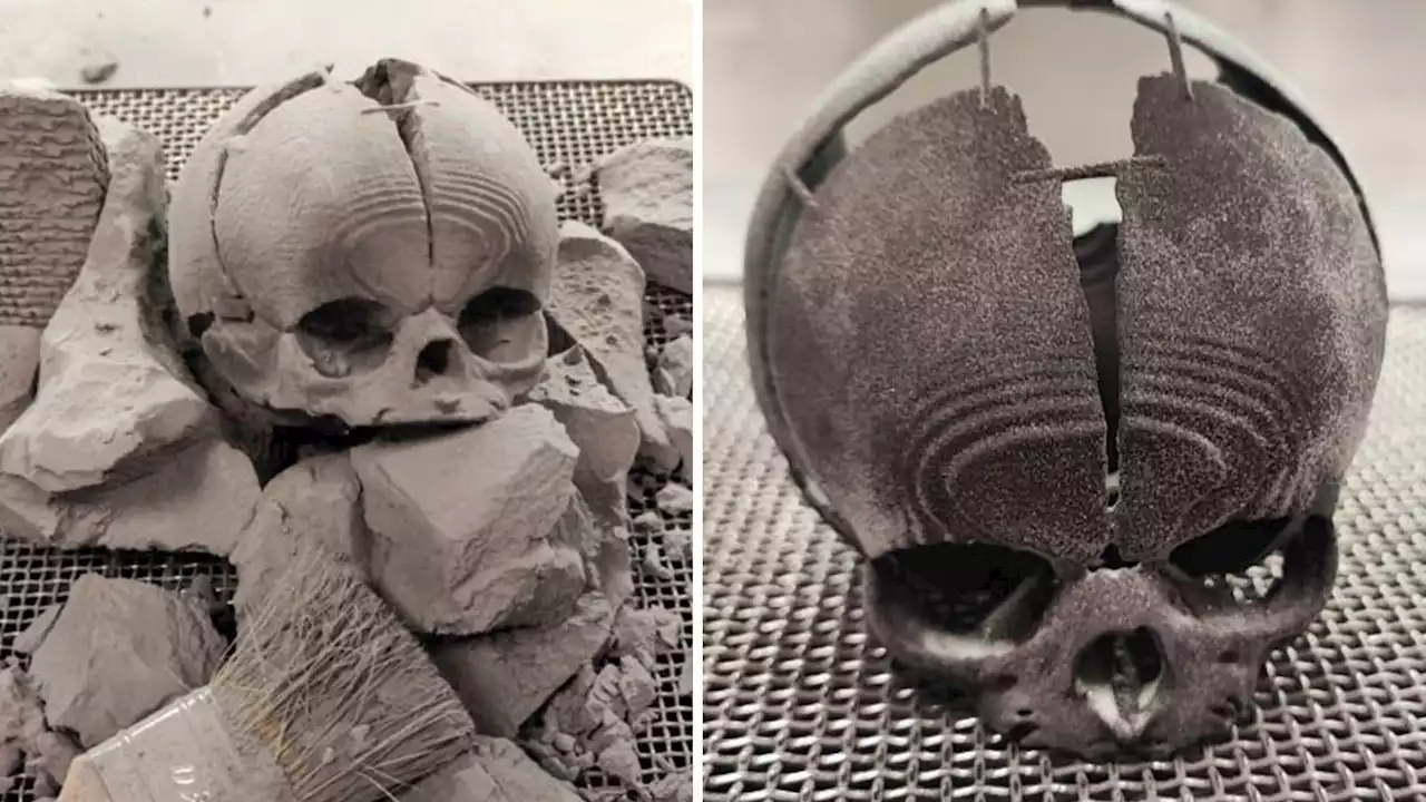 Engineers saved a baby's life by printing the missing part of her skull