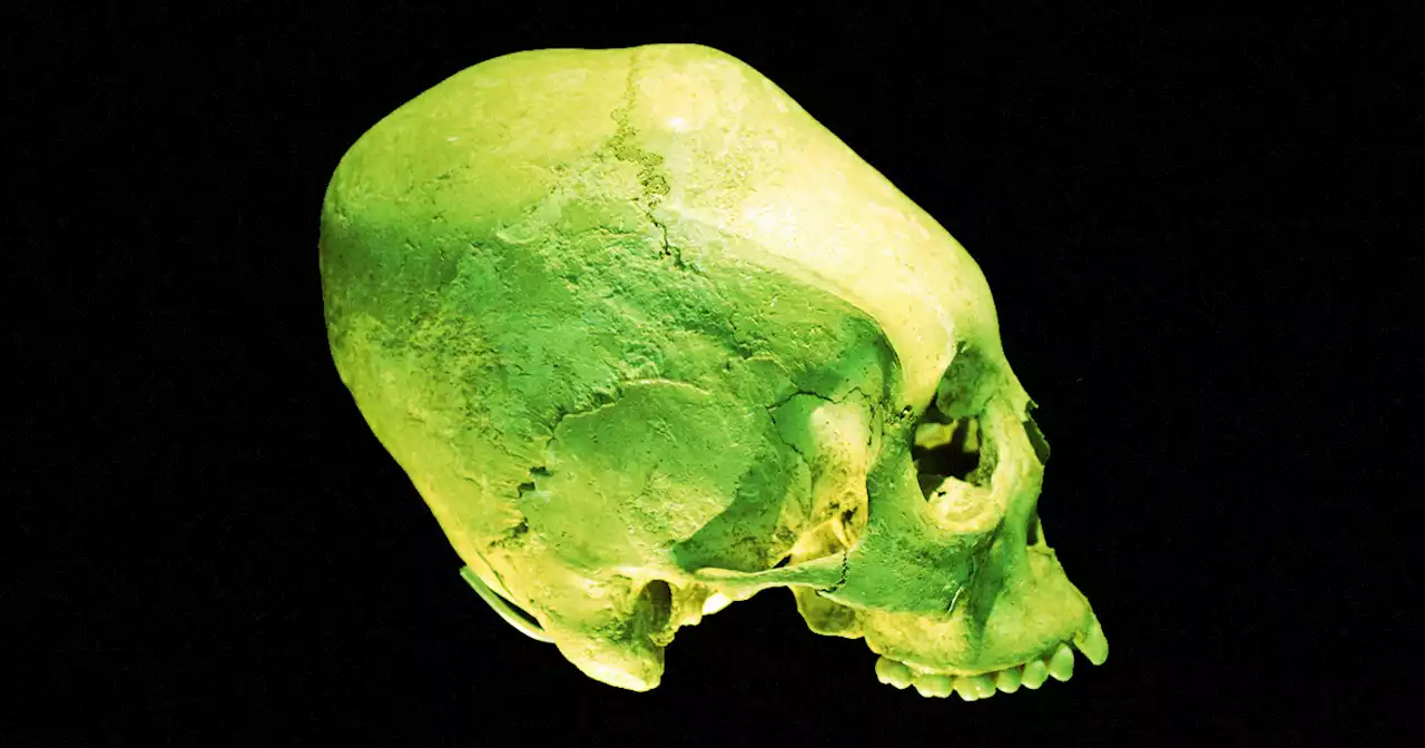 These Alien-Looking Skulls Are Actually Human, Expert Says