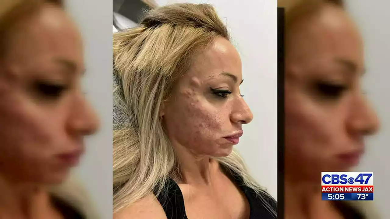 ‘Botox bandit,’ woman skips out on her nearly $2,600 botox bill at Jacksonville Beach med spa