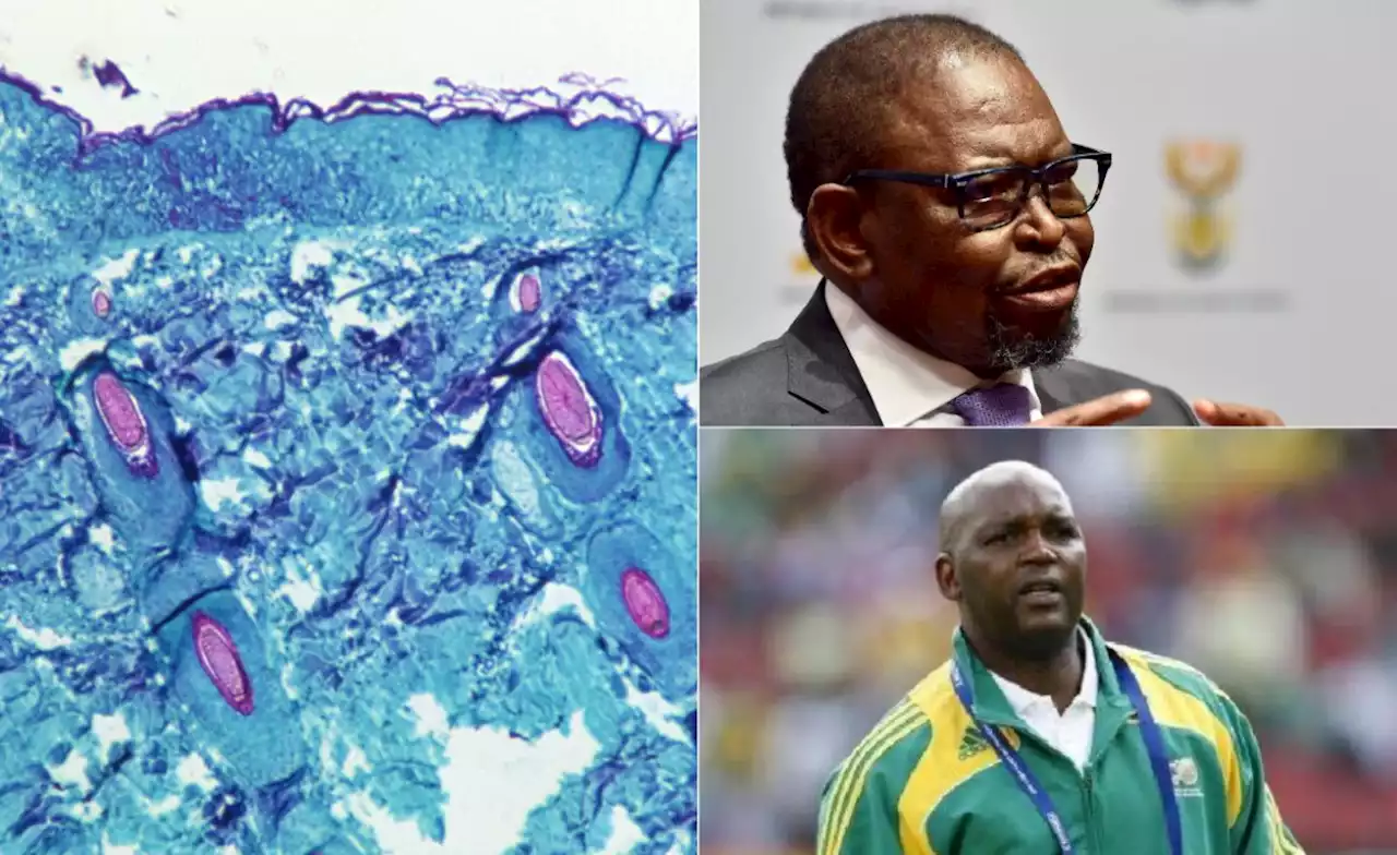 South Africa: Fifth Monkeypox Case Recorded - South African News Briefs - August 19, 2022