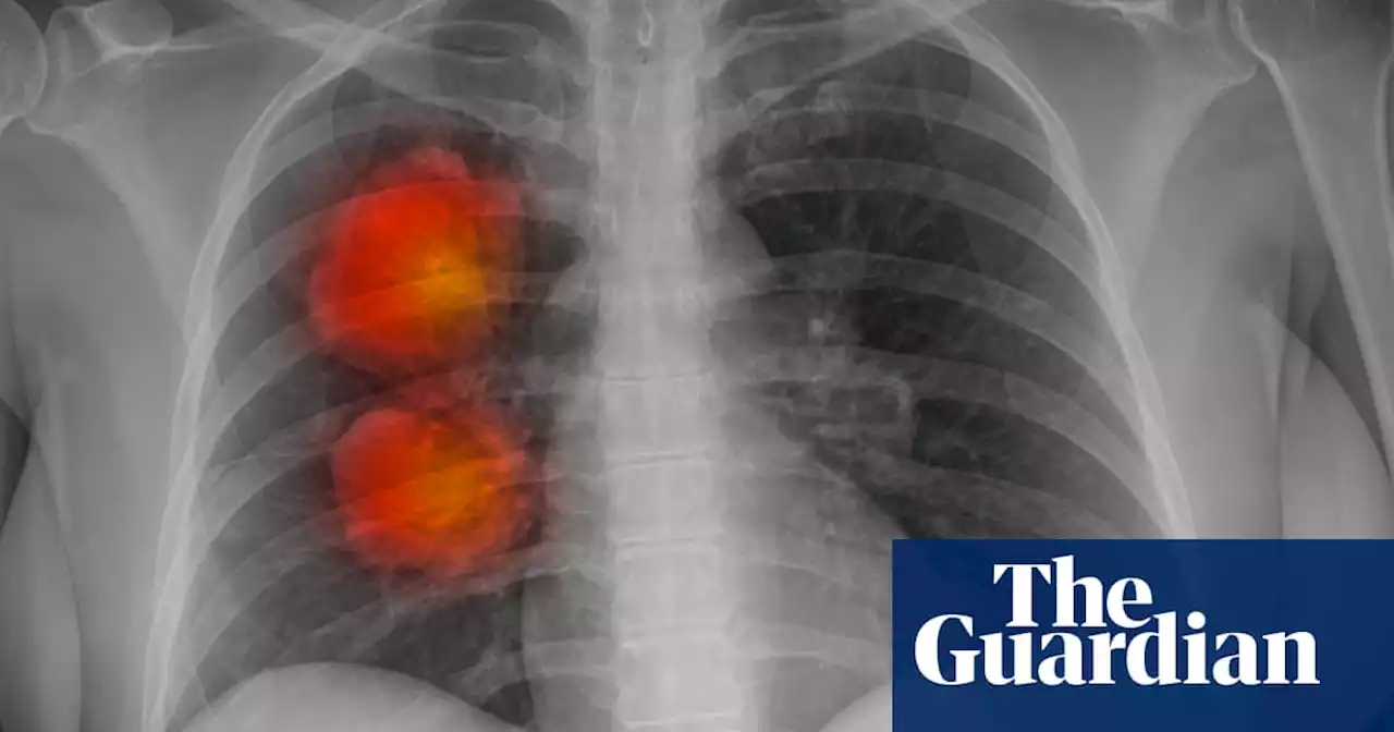 Risk factors such as smoking behind almost half of cancer deaths, finds study