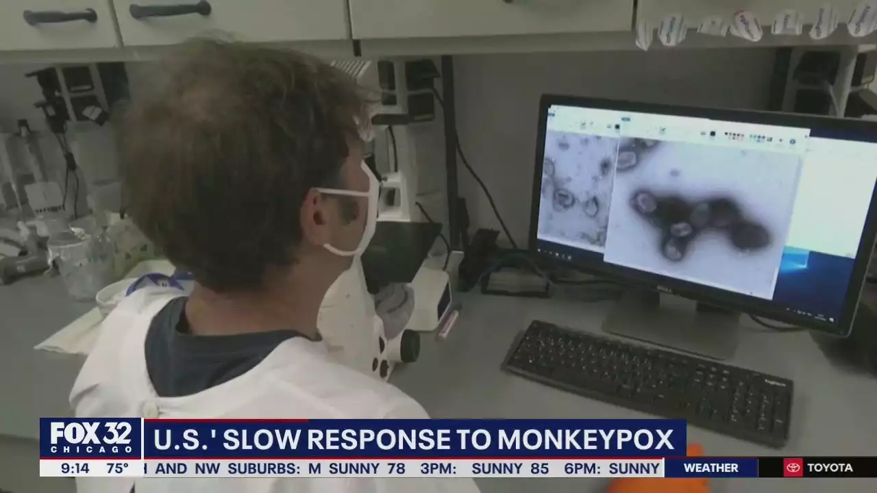 Medical community sounds alarm as monkeypox cases increase across U.S.