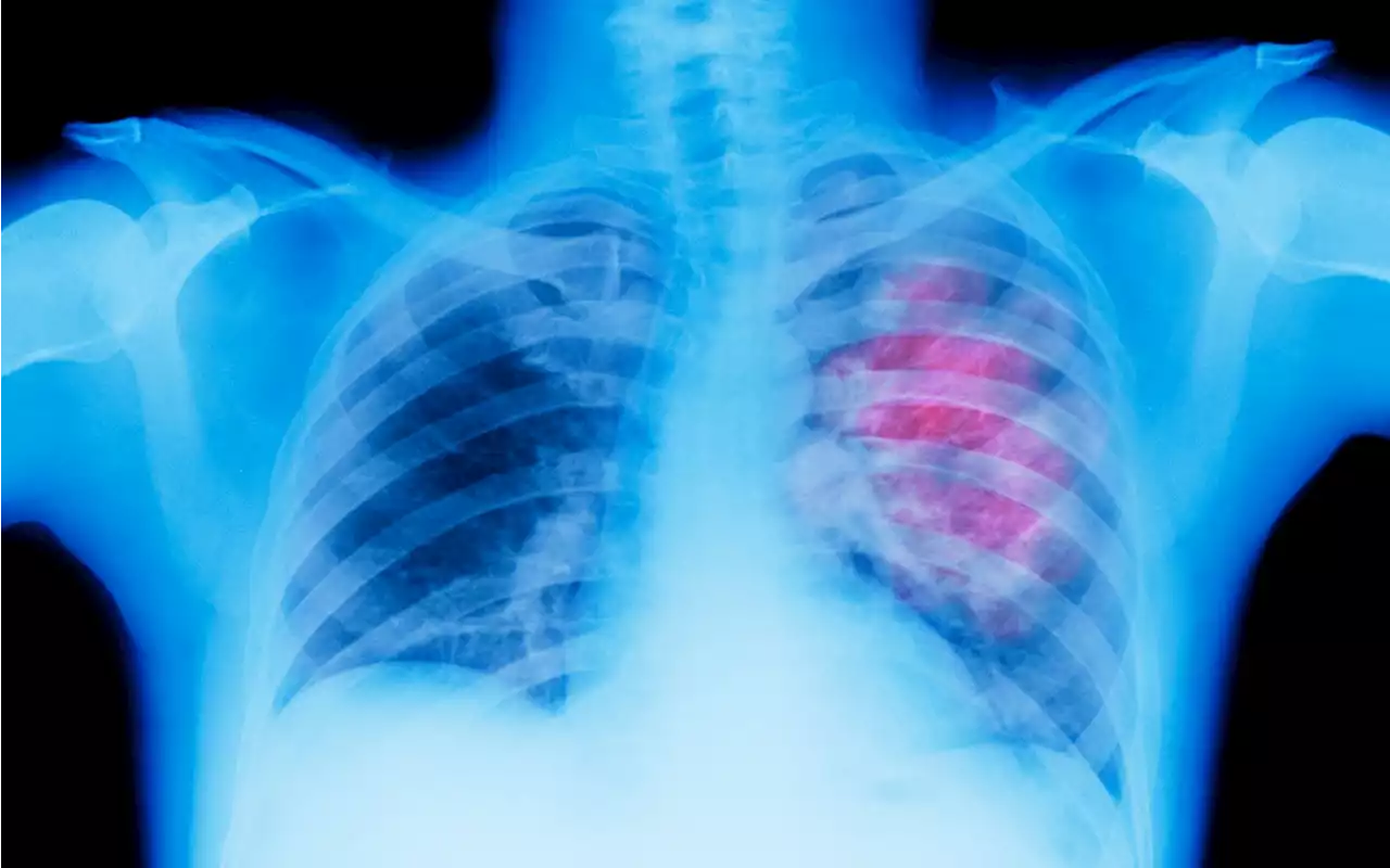 NHS campaign urges people not to ignore lung cancer symptoms