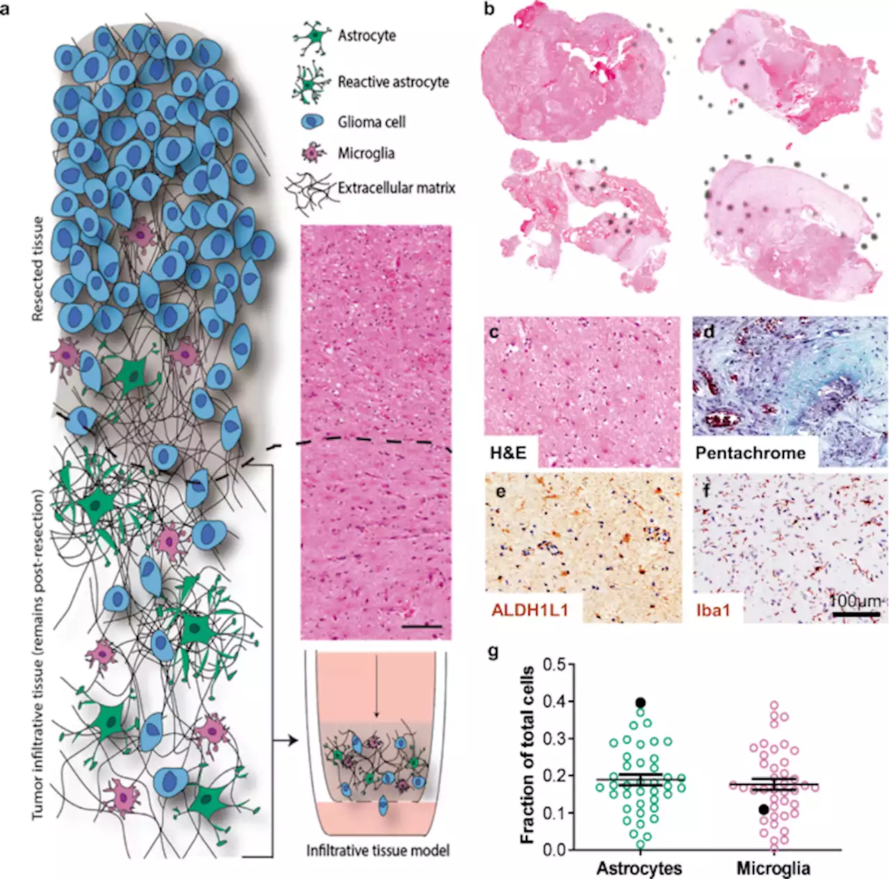 A patient-designed tissue-engineered model of the infiltrative glioblastoma microenvironment - npj Precision Oncology