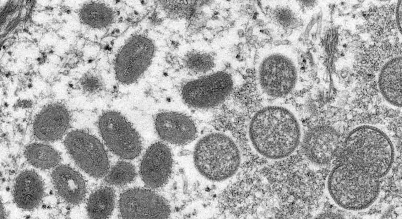 Índia confirma morte de um homem com varíola do macaco