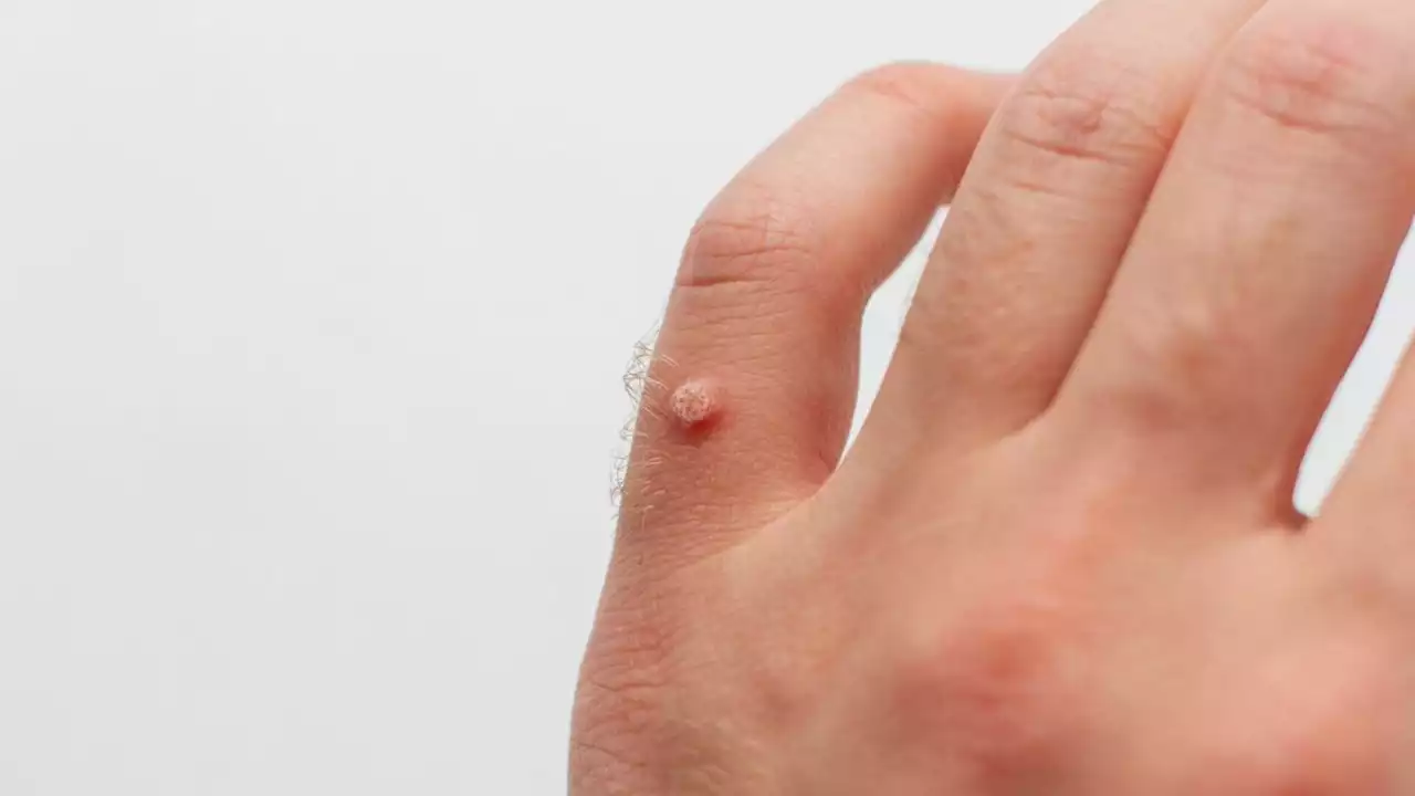 Asking for a Friend: Why are my hands covered in warts?