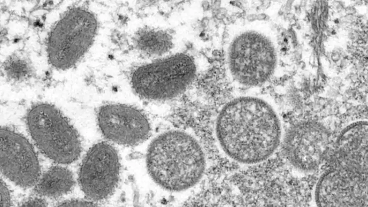 New York State Health Department confirms first known case of monkeypox in juvenile