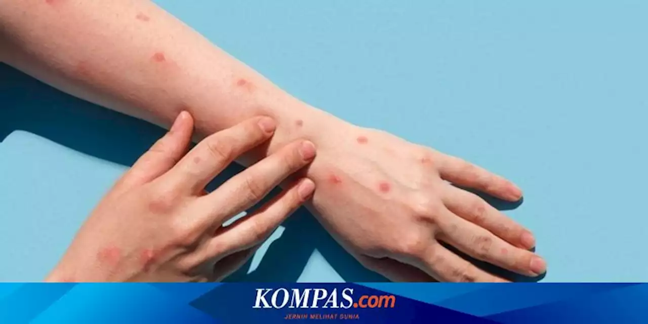 Cacar Monyet Masuk Indonesia, IDI Minta Masyarakat Tidak Panik