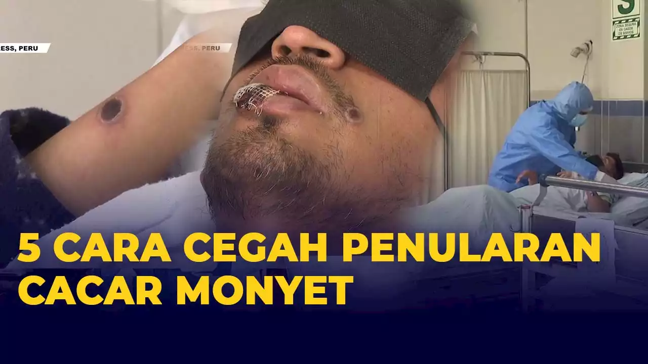 5 Cara Cegah Penularan Cacar Monyet yang Perlu Diketahui, Kenali Gejalanya