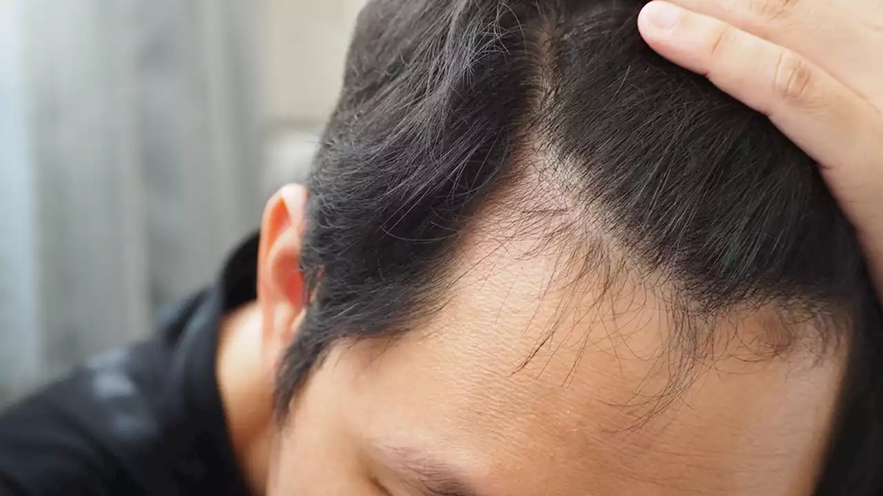 Why doctors are prescribing a cheap, well-known drug as an off-label cure for hair loss