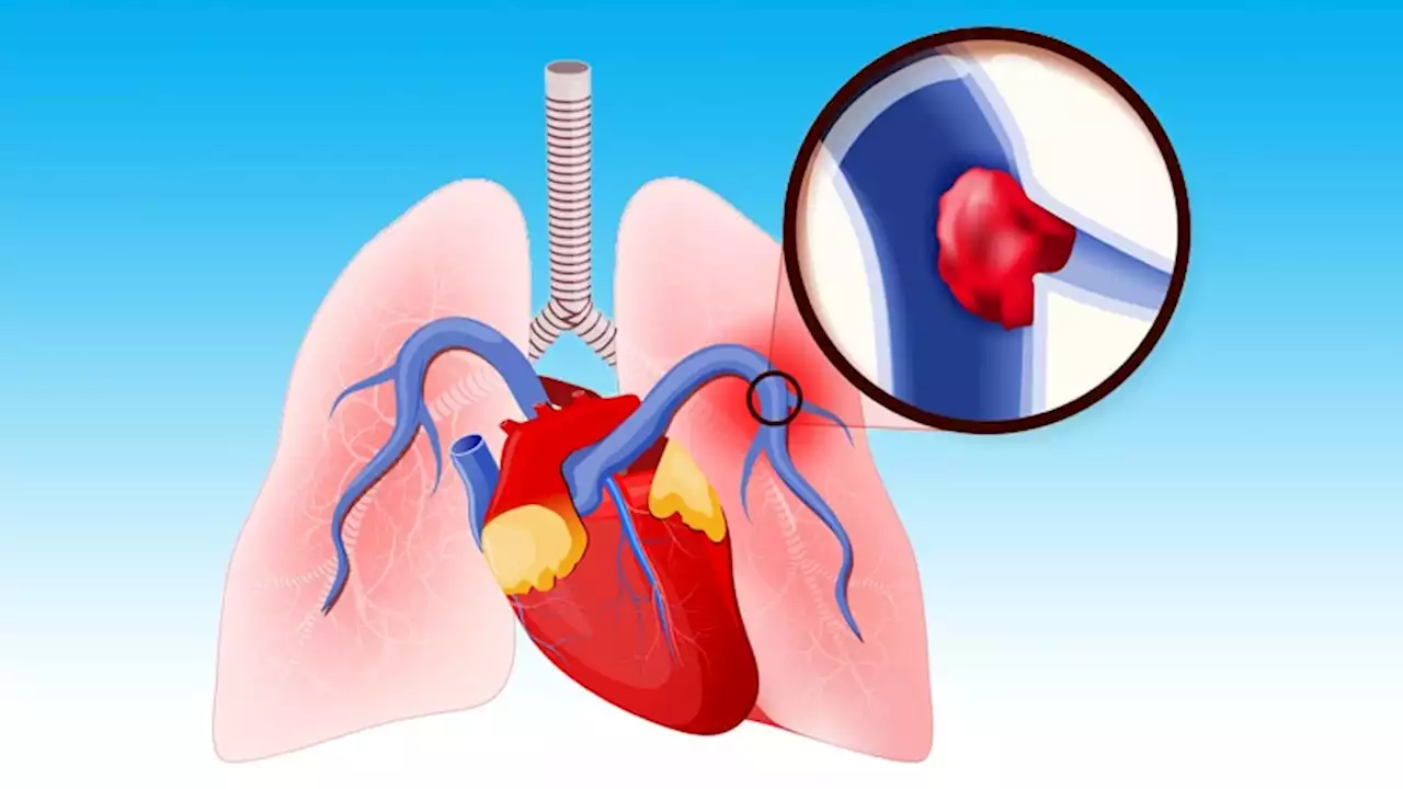 Sex Matters in Treatment Outcomes for Pulmonary Embolism