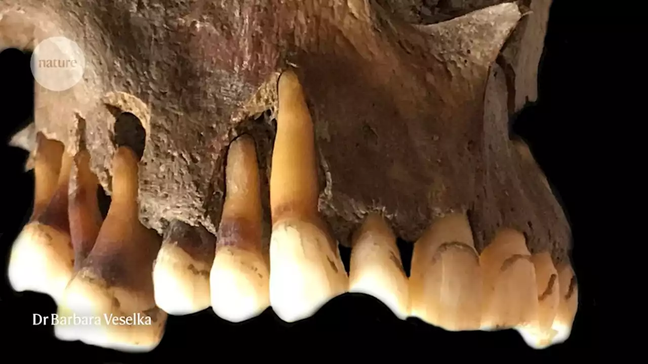 Ancient tooth DNA reveals how ‘cold sore’ herpes virus has evolved