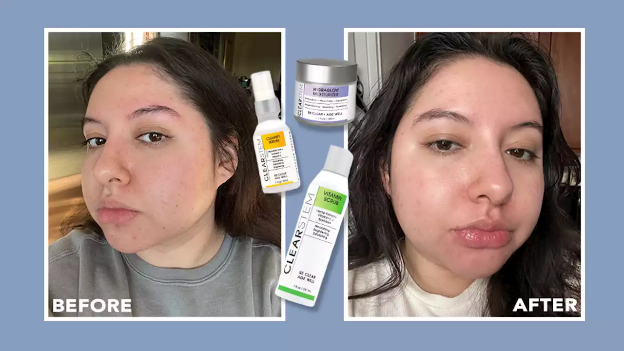 I Finally Found a Holy Grail Line for Acne-Prone Skin That Tackles Dark Spots & Fine Lines