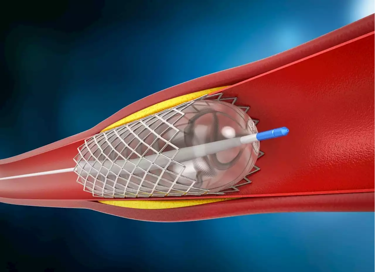 Are Nanoparticle Coatings the Solution to Next Generation Stents?