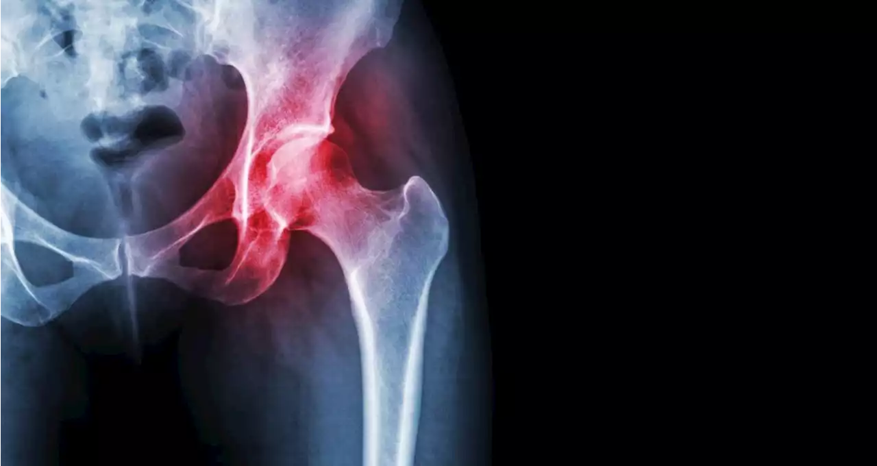 Vegetarian Women Have a Higher Risk of Hip Fracture