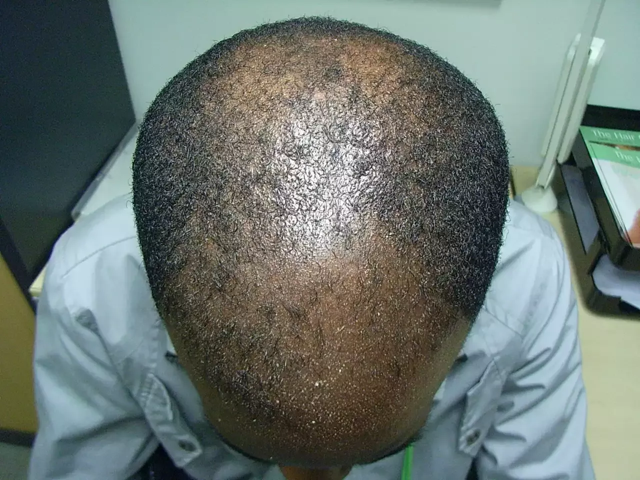 FACT CHECK: Does masturbation cause hair loss in men? | TheCable