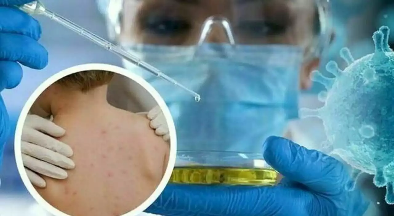 Vaiolo delle scimmie, possibile «quarantene dopo contatti e vaccinazione mirata»: la circolare del ministero della Salute